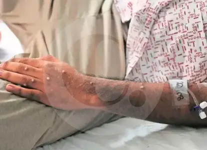 Van 88 casos de viruela símica en Antioquia. ¿Hay que encender las alarmas?